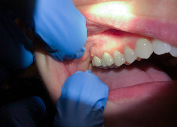 Best Knocked-Out Tooth (Avulsed Tooth) Treatment in East Syracuse, NY
